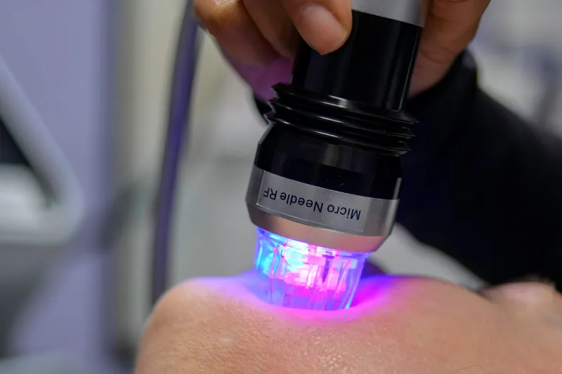 Scarlet RF microneedling skin tightening treatment at MC Aesthetics in McMinnville, Oregon (Yamhill County)